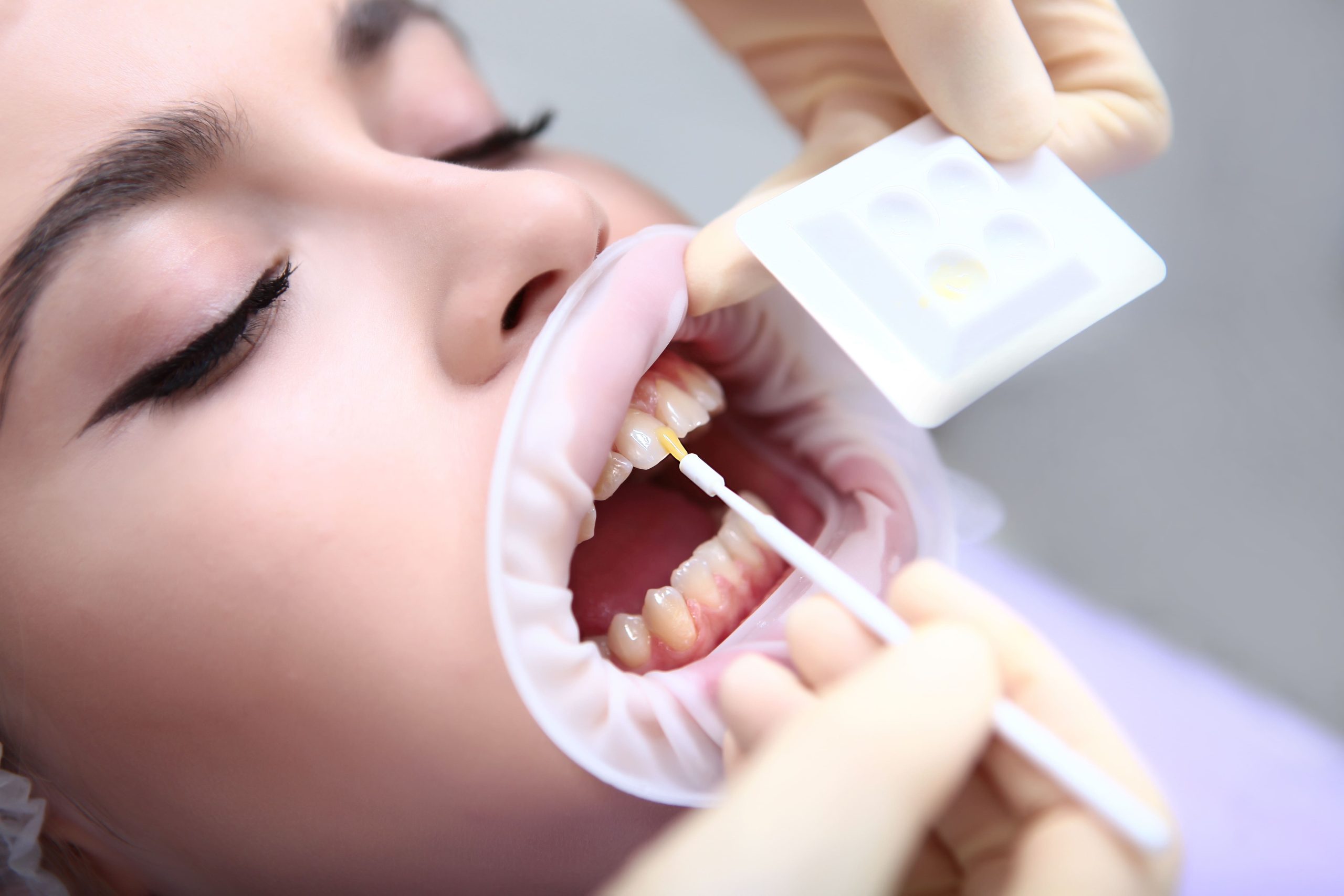 Odontopediatra aplicando flúor a un niño
